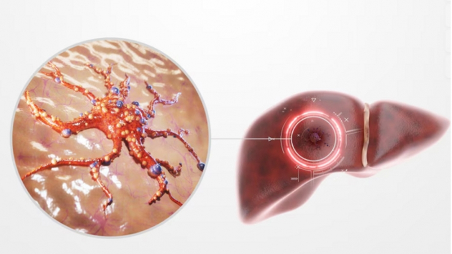 4 thực phẩm là "hung thần" bức tử gan, nên làm 2 việc để cứu gan
